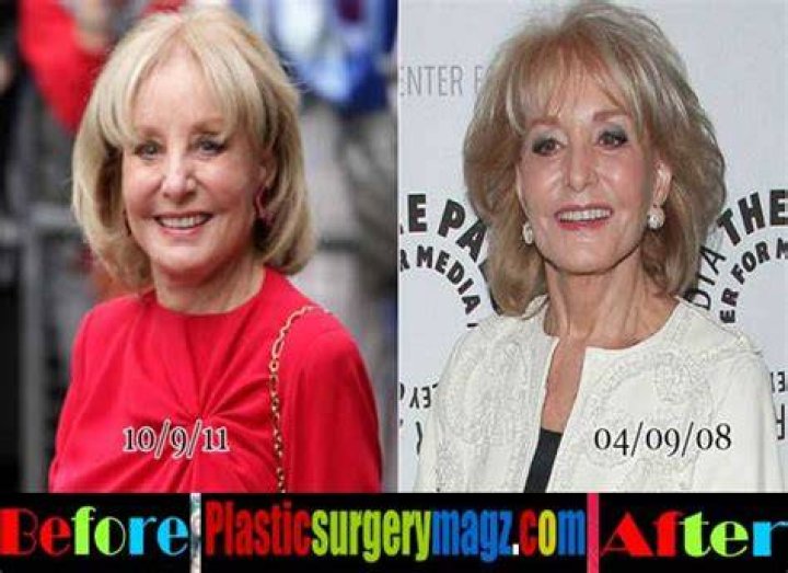 Barbara Walters Facelift Plastic Surgery Before and After