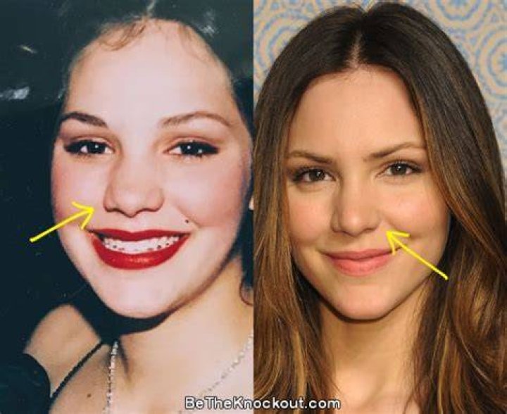 Katharine McPhee Plastic Surgery Before and After